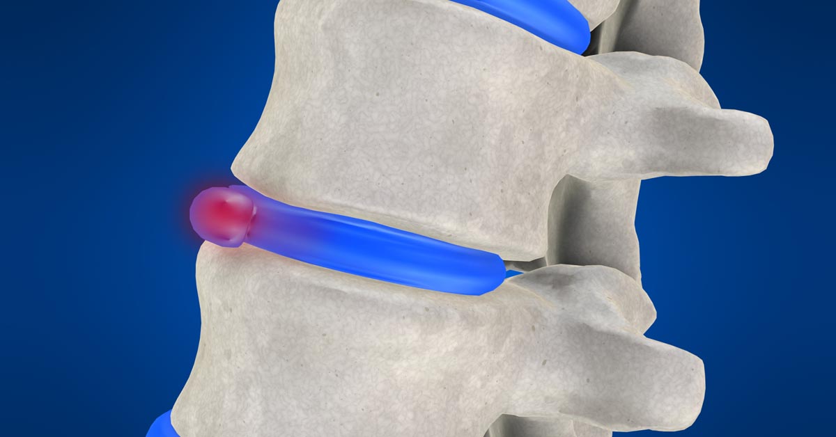 Noblesville non-surgical disc herniation treatment