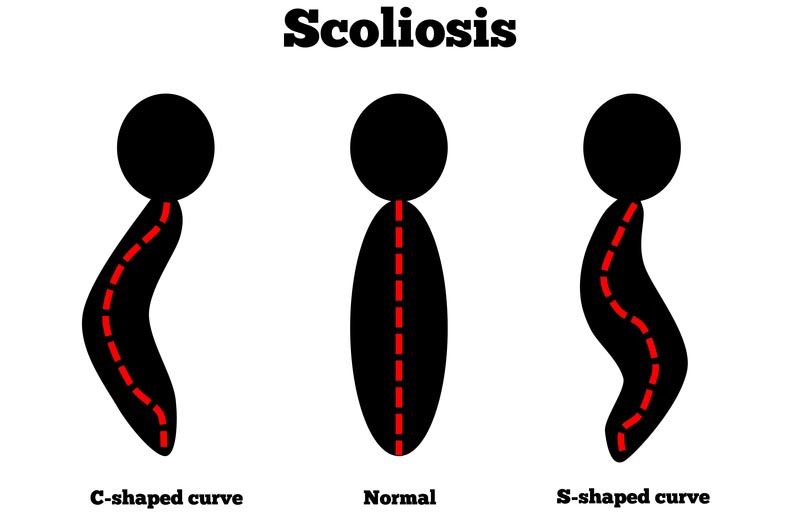 Noblesville, IN scoliosis treatment